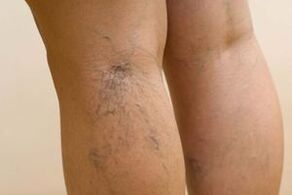 Comment les varices se manifestent chez les femmes