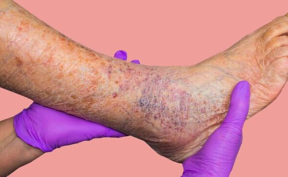 Pourquoi les varices sont dangereuses