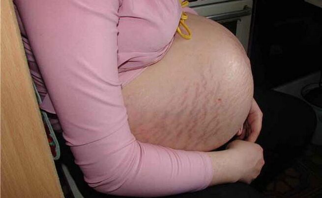 Causes des varices pendant la grossesse