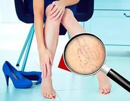 Les symptômes dépendent de la nature et du stade des varices