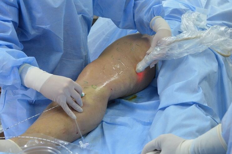 chirurgie des varices dans les jambes