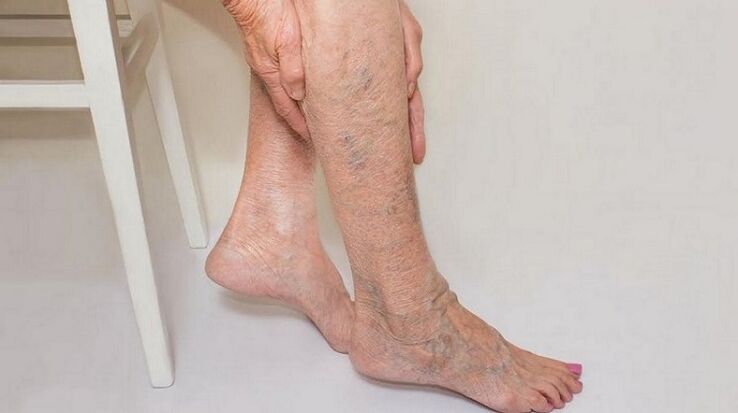 varices sur les jambes