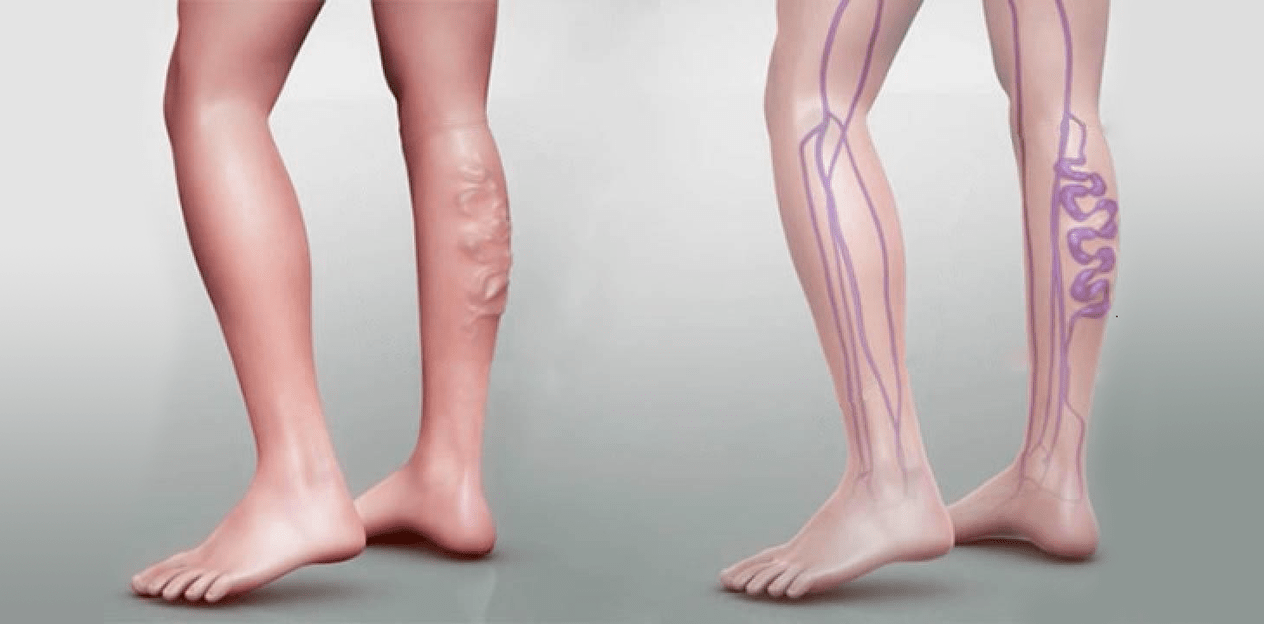 jambes saines et varices