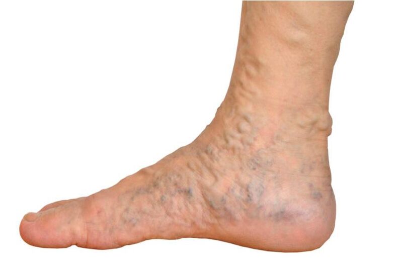 Varices sur la jambe