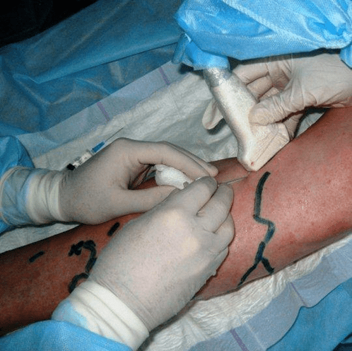 traitement chirurgical des varices