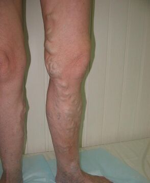 veines enflées sur la jambe à cause de varices